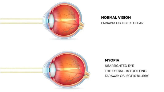 Understanding Myopia: Causes, Symptoms, and Treatment